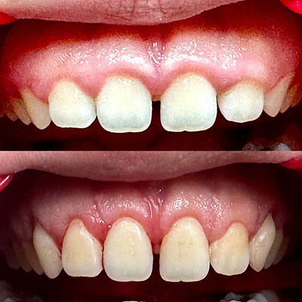 Gummy Smiles Correction