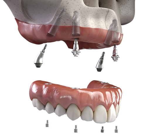 A diagram showing how a full denture is attached to dental implants