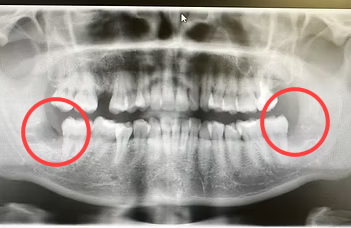Dental X-ray after wisdom teeth extraction