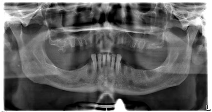 Single panoramic X-ray of the entire jaw and all teeth