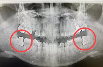 Panoramic dental X-ray highlighting the lower left and right wisdom teeth