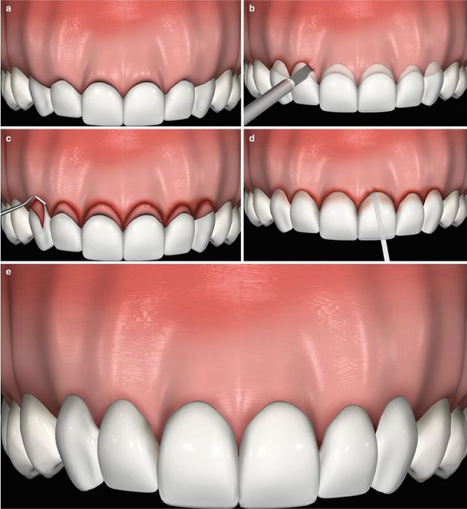 bellevue-crown-lengthening bellevue-crown-lengthening